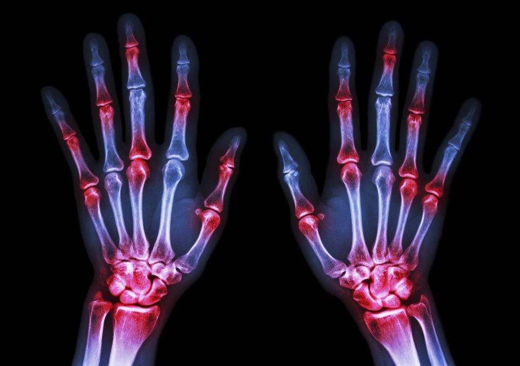 TS-490991087 MSM Hands-arthritis